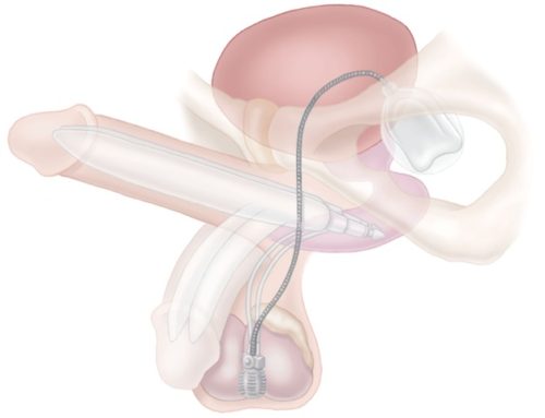 penile implant